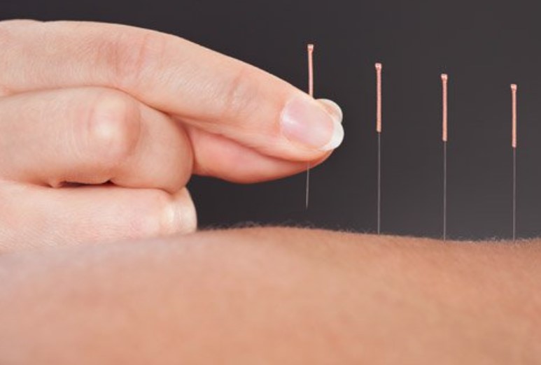 Akupunktur